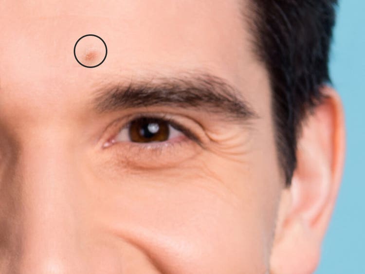 Aplicação de pinceladas suaves sobre acne no rosto de um homem.