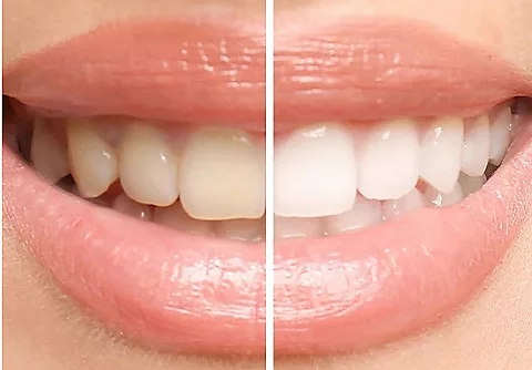 Foto dei denti di una persona prima e dopo una modifica. I denti sono più bianchi nella foto ritoccata.